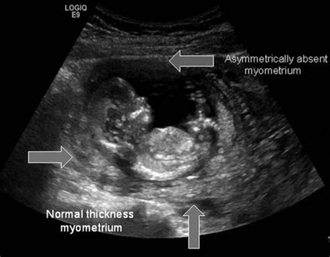 Trans abdominal ultrasound image showing an interstitial pregnancy at ...