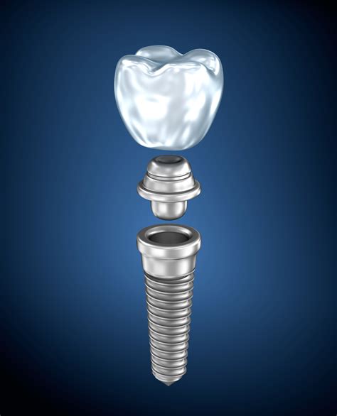 Your Implant Dentist in Kansas City for a Complete Smile