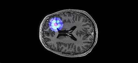 Quantum technology for cancer imaging