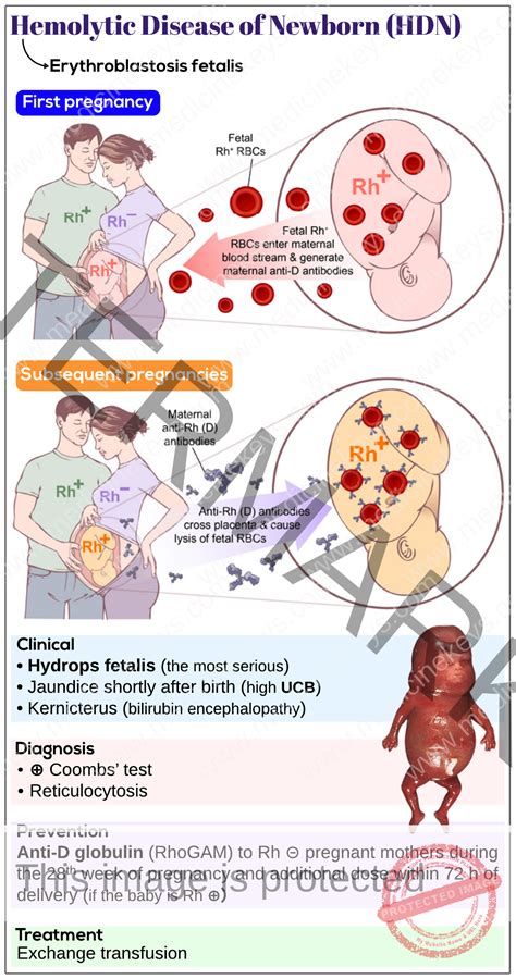 Hemolytic disease of the newborn (HDN) - Medicine Keys for MRCPs