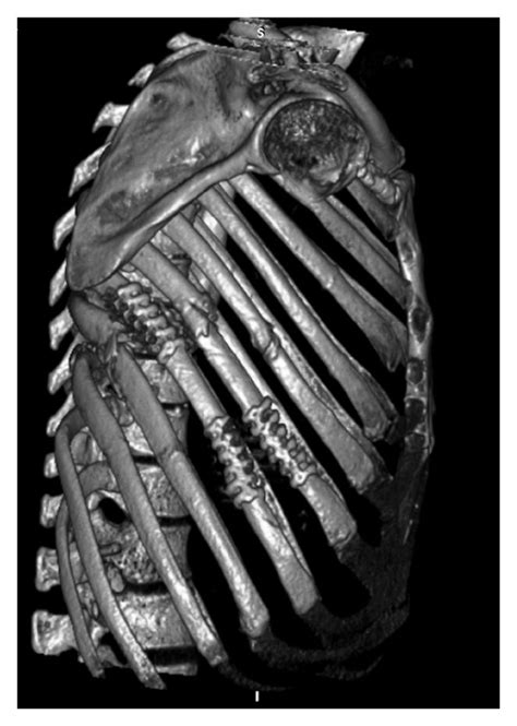 3D-computed tomography bony thorax reconstruction (a) demonstrating ...