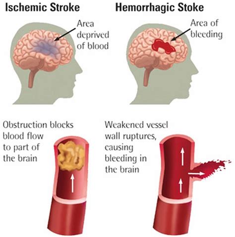 Tipos de accidente cerebrovascular: isquémico, hemorrágico y AIT | 2024