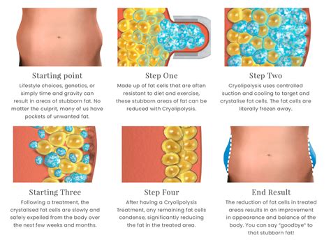 Individual treatment – fat freezing – Image is Aesthetics