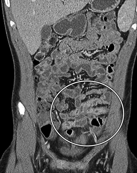 Endoscopic Skipping of the Terminal Ileum in Pediatric Crohn Disease | AJR