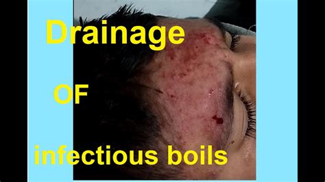 How To Quickly And Easily Drain Infectious Boils - YouTube