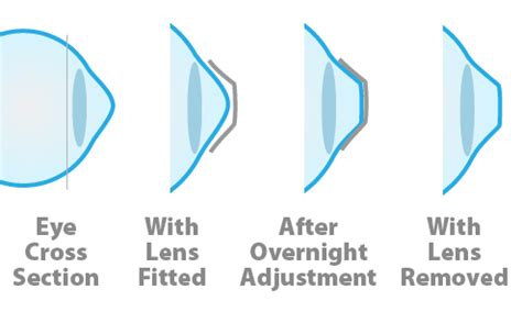 Things You Must Know About Orthokeratology | MD-Health.com