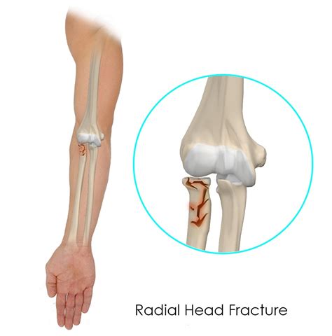 Radial Head Fractures Westchester NY | Elbow Joint Pain White Plains NY