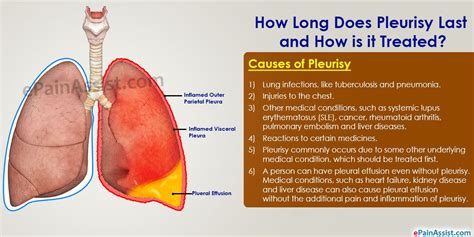 How Long Does Pleurisy Last and How is it Treated? | Anatomy ...