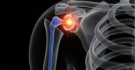 Shoulder Arthroscopy: Purpose, Preparation, Procedure, Recovery & Risks