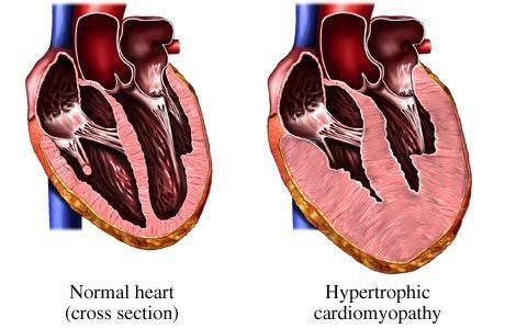 Idiopathic Hypertrophic Subaortic Stenosis (IHSS) Basics Description ...