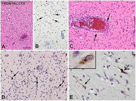 Histopathology rabies encephalitis due to Duvenhage virus. Rabies ...