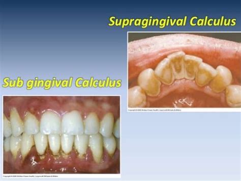 Subgingival Calculus causes bone loss around the t