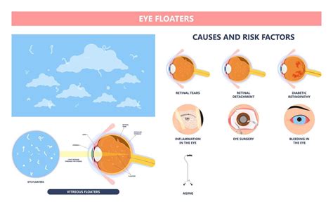 Eye Floaters: Causes & How to Get Rid of Them for Good | NVISION