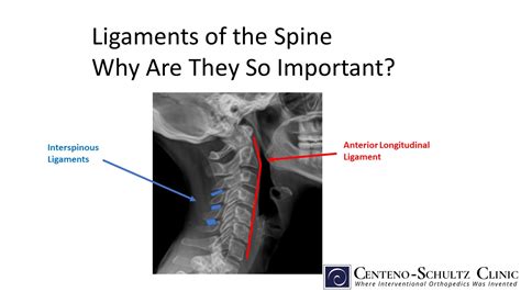 Interspinous Ligament Sprain