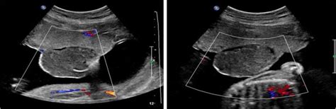 Antenatal embolization of a large placental chorioangioma: a case ...