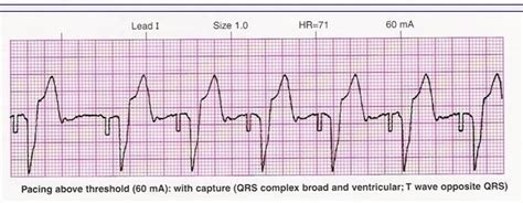 Transcutaneous Pacing — Downeast Emergency Medicine