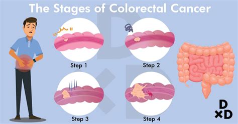 Stages Of Colorectal Cancer