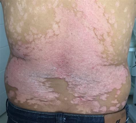 Psoriasis/ Eczema | Rederm Medical Center