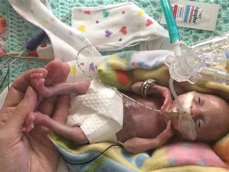 Earliest premature baby ever delivered is now a toddler