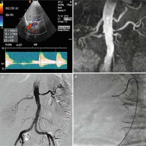 Renal Artery Stenosis | Radiology Key