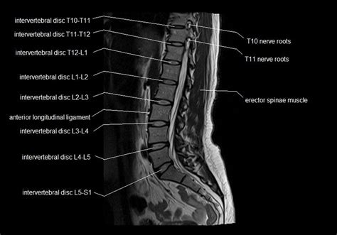 Mri Lumbar Spine Labeled