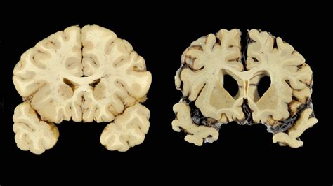 Cte Brain Compared To Normal Brain : Mri Of Truamatic Brain Injury By Dr David J Mikulis Youtube ...