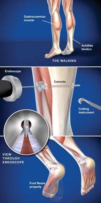 Gastrocnemius Recession (Intramuscular Approach) Resurgens Orthopaedics ...