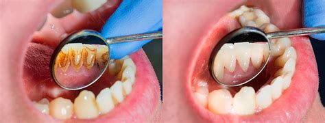 Los Beneficios De Una Limpieza Dental Profunda - Clínica Dental Alberto Rosenberg