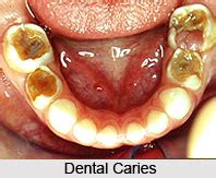 Dental Caries