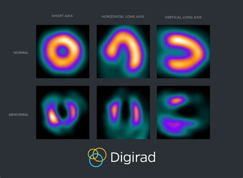 What is SPECT imaging and how does it work? | Nuclear Imaging