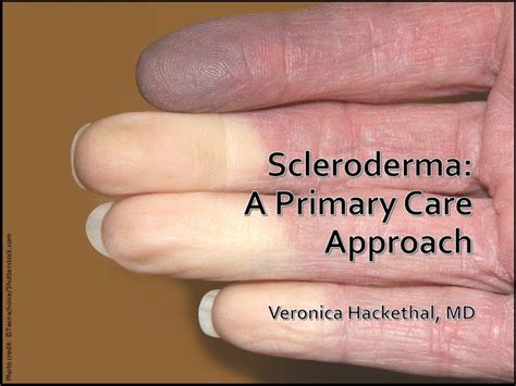 Scleroderma: A Primary Care Approach