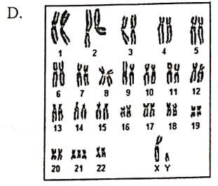 Down syndrome merupakan kelainan genetik hasil proses gagal berpisah dari meiosis. gambaran ...