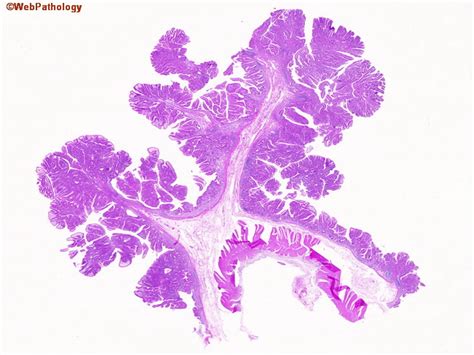 Webpathology.com: A Collection of Surgical Pathology Images