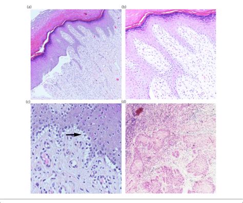 (a-c) Epidermolysis bullosa simplex: A, noninflamed subepidermal ...