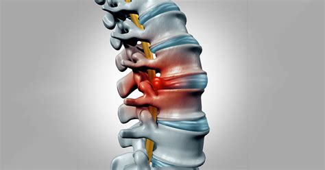 Cervical Myelopathy | Scottsdale, AZ Orthopedic Spine Surgery