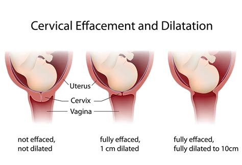 Cervical Dilation