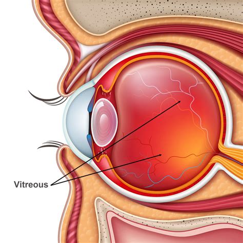 Vitreous | Eye Patient