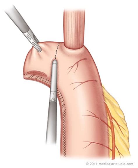 Minimally Invasive Esophagectomy | Stanford Health Care