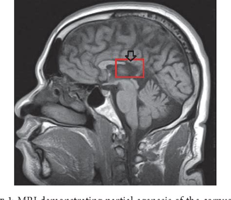 Figure 1 from Neuropsychiatric Manifestations of Partial Agenesis of ...