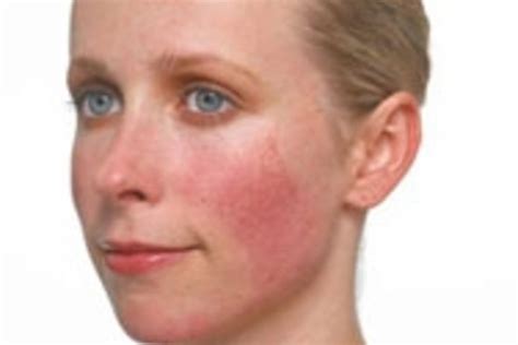 Beauty Tip of the Day - Ruddy Cheeks | Natural rosacea treatment, Rosacea acne treatment ...