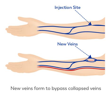 What is a collapsed vein? » Ask Our Doctors (by JourneyPure)