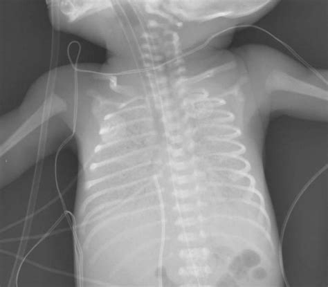 HYALINE MEMBRANE DISEASE | Buyxraysonline