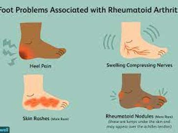 Joint Pain in the Feet: A Symptom of Rheumatoid Arthritis