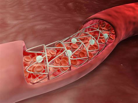 Restenosis After Angioplasty and Stenting