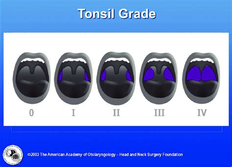 Subjective tonsil grading scale. | Download Scientific Diagram