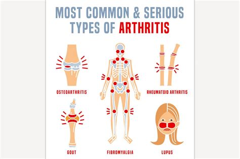 Arthritis types infographic | Icons ~ Creative Market