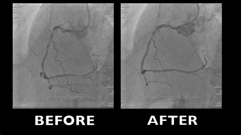 Video : Triple vessel disease treated with FFR guidance