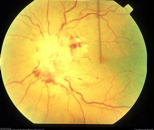 Waldenstrom Macroglobulinemia and Hyperviscosity-related Retinopathy