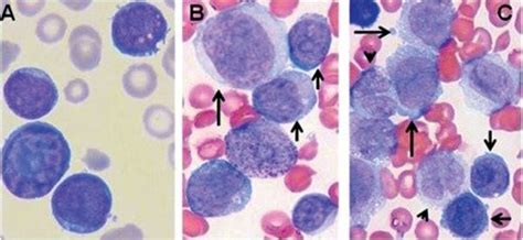 Morphology of blast cells at diagnosis (A) and in the course of fatal... | Download Scientific ...