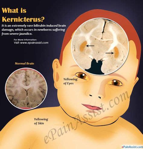 Kernicterus | Metabolic disorders, Medical education, Neonatal nurse